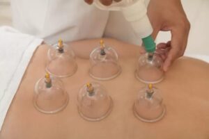 WET CUPPING / BEKAM BASAH